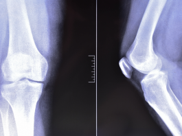 Gonartrosi, un nuovo trattamento per la rigenerazione delle cartilagini