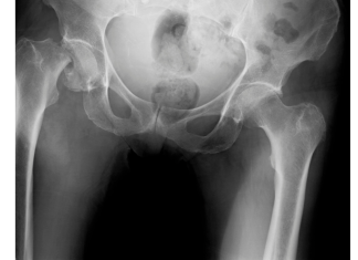 Migliorare il posizionamento della capsula acetabolare con la realtà aumentata