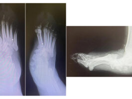 Piede di Charcot, rara complicanza del diabete: al Gemelli soluzioni avanzate