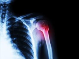 Lesione del nervo radiale nelle fratture dell'omero: l'importanza della tempestivit&agrave;