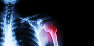 Lesione del nervo radiale nelle fratture dell'omero: l'importanza della tempestività