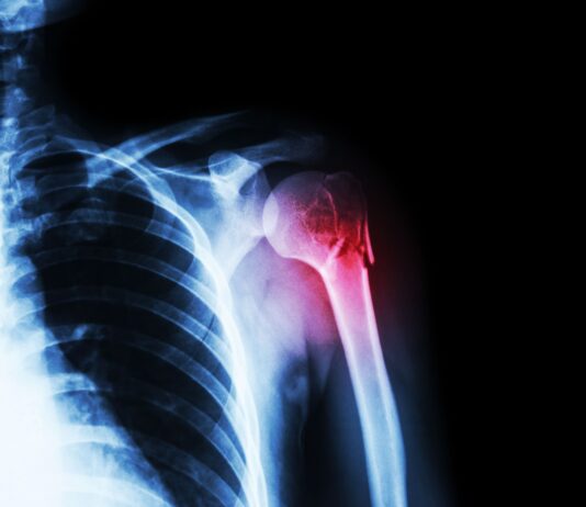 Lesione del nervo radiale nelle fratture dell'omero: l'importanza della tempestività