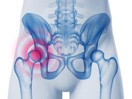 Fratture acetabolari e pelviche e ritorno allo sport