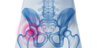 Fratture acetabolari e pelviche e ritorno allo sport