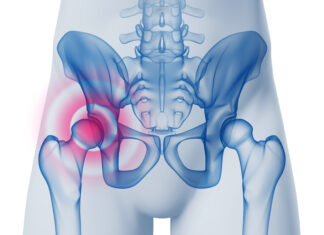 Fratture acetabolari e pelviche e ritorno allo sport Fratture acetabolari e pelviche e ritorno allo sport