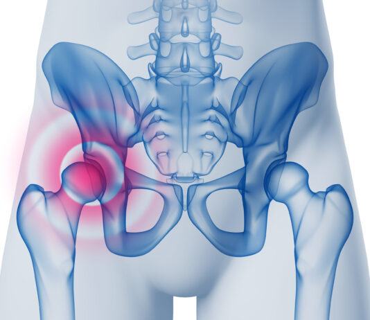 Fratture acetabolari e pelviche e ritorno allo sport
