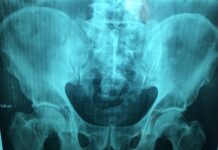 Tromboembolismo venoso nelle fratture pelviche: fattori di rischio e come prevenirlo