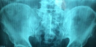 Tromboembolismo venoso nelle fratture pelviche: fattori di rischio e come prevenirlo