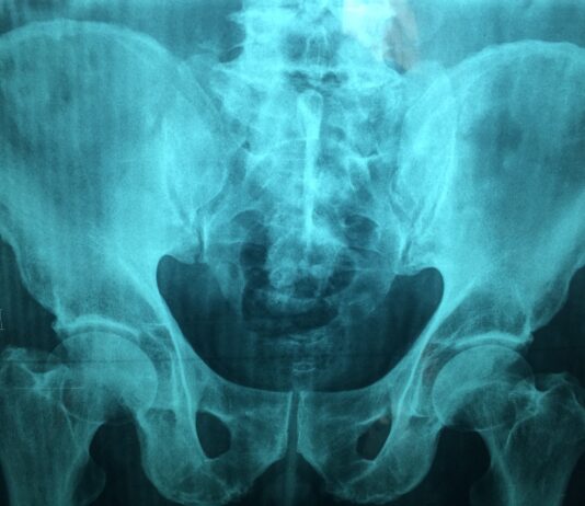 Tromboembolismo venoso nelle fratture pelviche: fattori di rischio e come prevenirlo