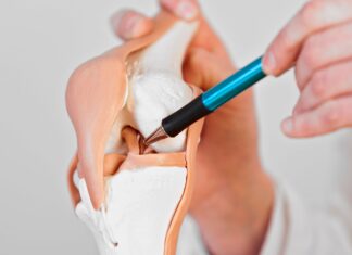 Intervento di riparazione del crociato anteriore, l’efficacia della riabilitazione digitale Intervento di riparazione del crociato anteriore, l'efficacia della riabilitazione digitale