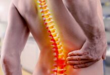 La fusione lombare aumenta il rischio artrosi e artroplastica di anca?