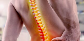 La fusione lombare aumenta il rischio artrosi e artroplastica di anca?