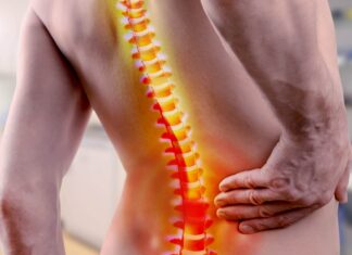 La fusione lombare aumenta il rischio artrosi e artroplastica di anca?