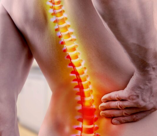 La fusione lombare aumenta il rischio artrosi e artroplastica di anca?