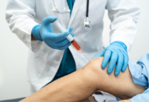 Gonartrosi, efficacia del plasma arricchito di piastrine