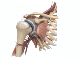 Protesi inversa: un nuovo metodo per il corretto posizionamento della componente gleno-omerale Protesi inversa: un nuovo metodo per il corretto posizionamento componente gleno-omerale