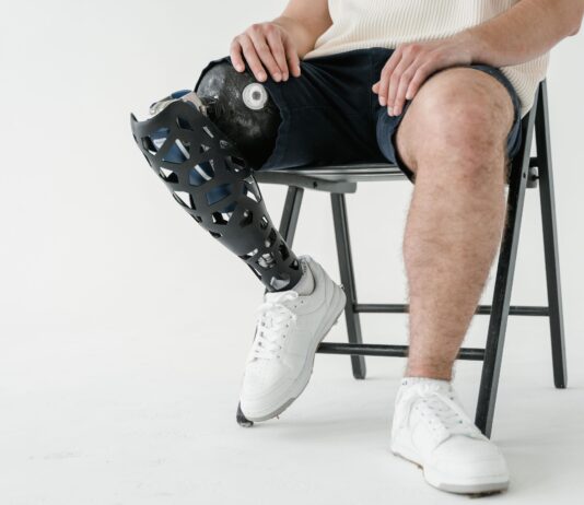 Stabilità dinamica e statica in pazienti con protesi post amputazione transfemorale Stabilità dinamica e statica in pazienti con protesi post amputazione transfemorale