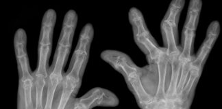 Artrite reumatoide, i rischi del sovrappeso