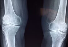 Fratture di caviglia: il protocollo ERAS riduce dolore post-operatorio e tempi di degenza