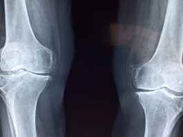 Fratture di caviglia: il protocollo ERAS riduce dolore post-operatorio e tempi di degenza