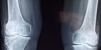 Fratture di caviglia: il protocollo ERAS riduce dolore post-operatorio e tempi di degenza