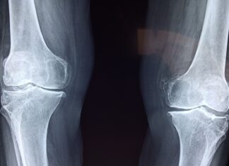 Fratture di caviglia: il protocollo ERAS riduce dolore post-operatorio e tempi di degenza