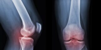 Esosomi nel trattamento dell'artrosi di ginocchio
