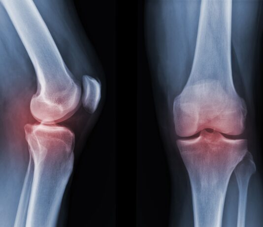 Esosomi nel trattamento dell'artrosi di ginocchio