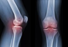 Artrosi, scoperto un nuovo interruttore biologico per rigenerare la cartilagine Instabilità di caviglia: gli effetti di un device vibrotattile