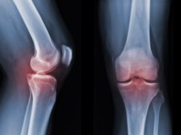 Artrosi, scoperto un nuovo interruttore biologico per rigenerare la cartilagine Instabilità di caviglia: gli effetti di un device vibrotattile