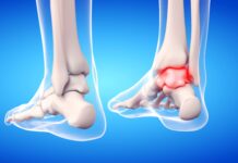 Instabilità di caviglia: gli effetti di un device vibrotattile Instabilità di caviglia: gli effetti di un device vibrotattile