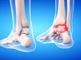 Instabilit&agrave; di caviglia: gli effetti di un device vibrotattile