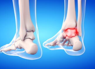 Instabilità di caviglia: gli effetti di un device vibrotattile Instabilità di caviglia: gli effetti di un device vibrotattile