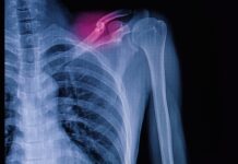 Frattura di clavicola del terzo medio: trattamento conservativo e chirurgico a confronto