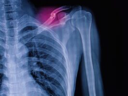 Frattura di clavicola del terzo medio: trattamento conservativo e chirurgico a confronto