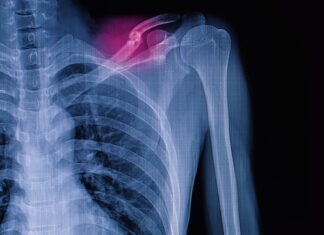 Frattura di clavicola del terzo medio: trattamento conservativo e chirurgico a confronto