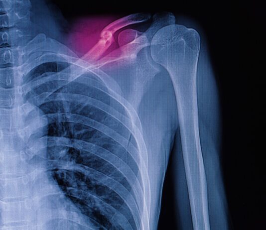 Frattura di clavicola del terzo medio: trattamento conservativo e chirurgico a confronto