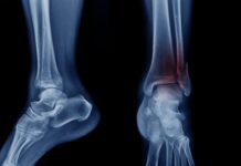 Fratture di caviglia: il protocollo ERAS riduce dolore post-operatorio e tempi di degenza