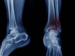 Fratture di caviglia: il protocollo ERAS riduce dolore post-operatorio e tempi di degenza
