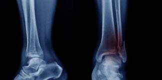 Fratture di caviglia: il protocollo ERAS riduce dolore post-operatorio e tempi di degenza