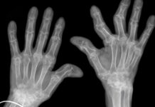 Artrite reumatoide: una nuova via dell’infiammazione potrebbe spiegare la resistenza ai farmaci