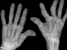 Artrite reumatoide: una nuova via dell&rsquo;infiammazione potrebbe spiegare la resistenza ai farmaci