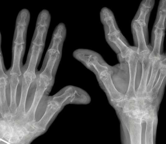 Artrite reumatoide: una nuova via dell&rsquo;infiammazione potrebbe spiegare la resistenza ai farmaci