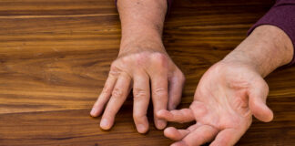 Artrite psoriasica: perché la psoriasi si trasforma in una malattia articolare? 