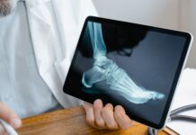 Frattura di caviglia: benefici della crioterapia di terza generazione preoperatoria