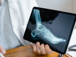 Frattura di caviglia: benefici della crioterapia di terza generazione preoperatoria