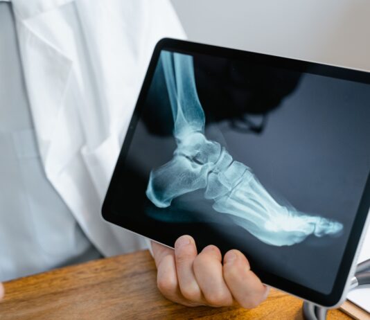 Frattura di caviglia: benefici della crioterapia di terza generazione preoperatoria