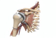 Lesione alla cuffia dei rotatori: sviluppato un sistema predittivo basato su parametri anatomici