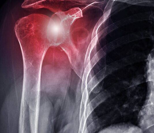 Capsulite adesiva di spalla in pazienti diabetici: come effettuare uno screening di popolazione