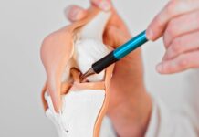 Lesione dei legamenti crociati anteriori: l'area dell'incisura femorale influenza l'outcome della riparazione?